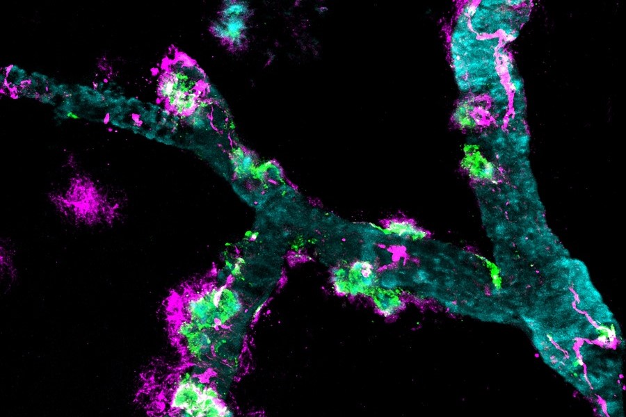 Diese Aufnahme zeigt ein Blutgefäß mit Ablagerungen von Amyloid­β und Medin (farblich markiert in Lila und Grün). Das Bild wurde am Computer eingefärbt.