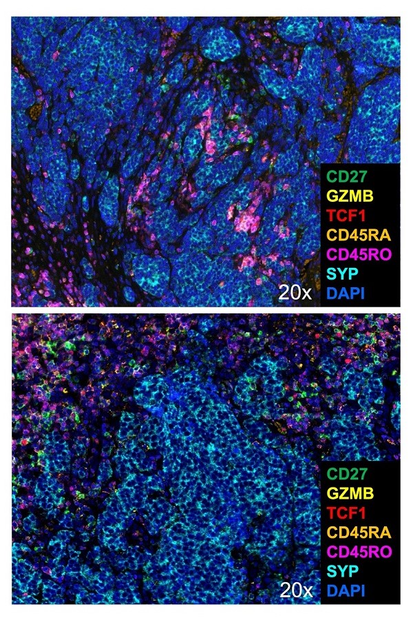 Multiplexe Immunfluoreszenz¬Färbungen für T¬Zellen und deren Differenzierungsstadien, die ein intratumorales (oben) und ein peritumorales Infiltrat im Merkelzellkarzinom (Syp - Synaptophysin) zeigen. 