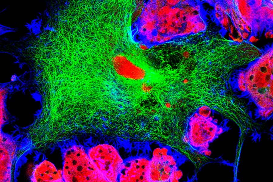 Neuroblastome im Mikroskop 
