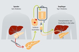 Grafische Darstellung: Aus dem Spenderorgan isolierte insulinproduzierende Zellen werden in die Leber des Empfängers übertragen