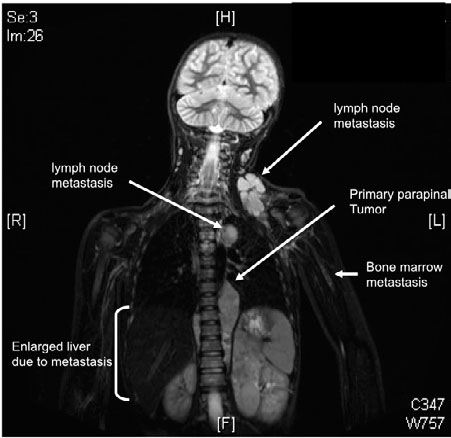 Magnetresonanzaufnahme eines Neuroblastom-Patienten, bei dem sich bereits Metastasen in den Lymphknoten und im Knochenmark gebildet haben. Au&szlig;erdem kann man den prim&auml;ren Tumor neben der Wirbels&auml;ule erkennen sowie eine wegen der Metastasen vergr&ouml;&szlig;erte Leber.