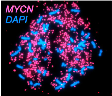 Fluoreszenzmikroskopie-Aufnahme der Chromosomen einer Neuroblastom-Zelle. Der blaue Farbstoff DAPI wurde zur Markierung der DNA eingesetzt. Mit einer Sonde f&uuml;r das MYC-Gen wurde die hundertfach erh&ouml;hte Kopienzahl von MYC in den Krebszellen in pink angef&auml;rbt.