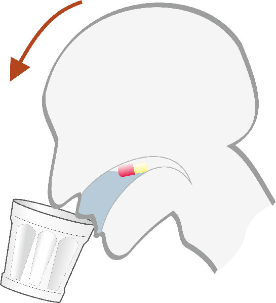 Der „Nick-Trick“ erleichtert das Schlucken von Kapseln.
