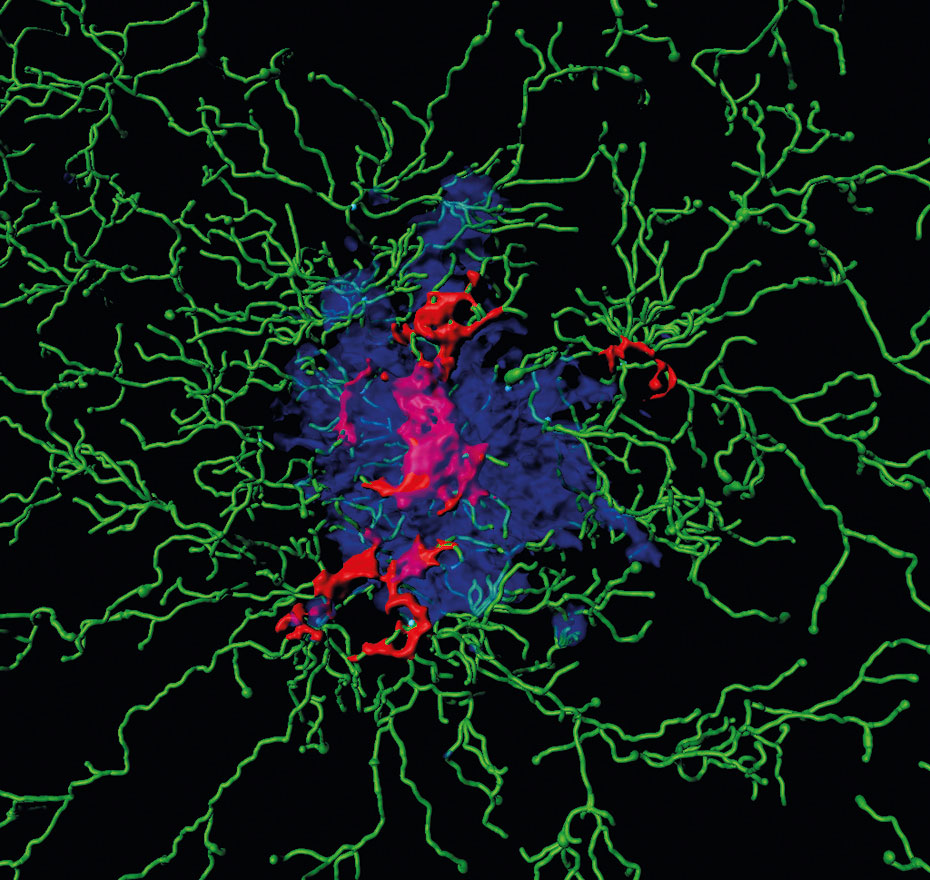 Ablagerungen im Gehirn: Dargestellt sind Entzündungsproteine (sogenannte ASC Specks, rot) im Kern einer Ansammlung von Amyloid-Beta-Peptiden (blau) sowie Immunzellen (grün).