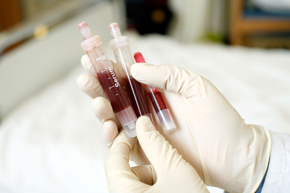 Der neu entwickelte Test ermöglicht eine frühe Diagnose auf HLA-Verlust Rezidive.