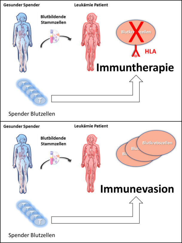 Grafik zu Knochenmarktransplantation