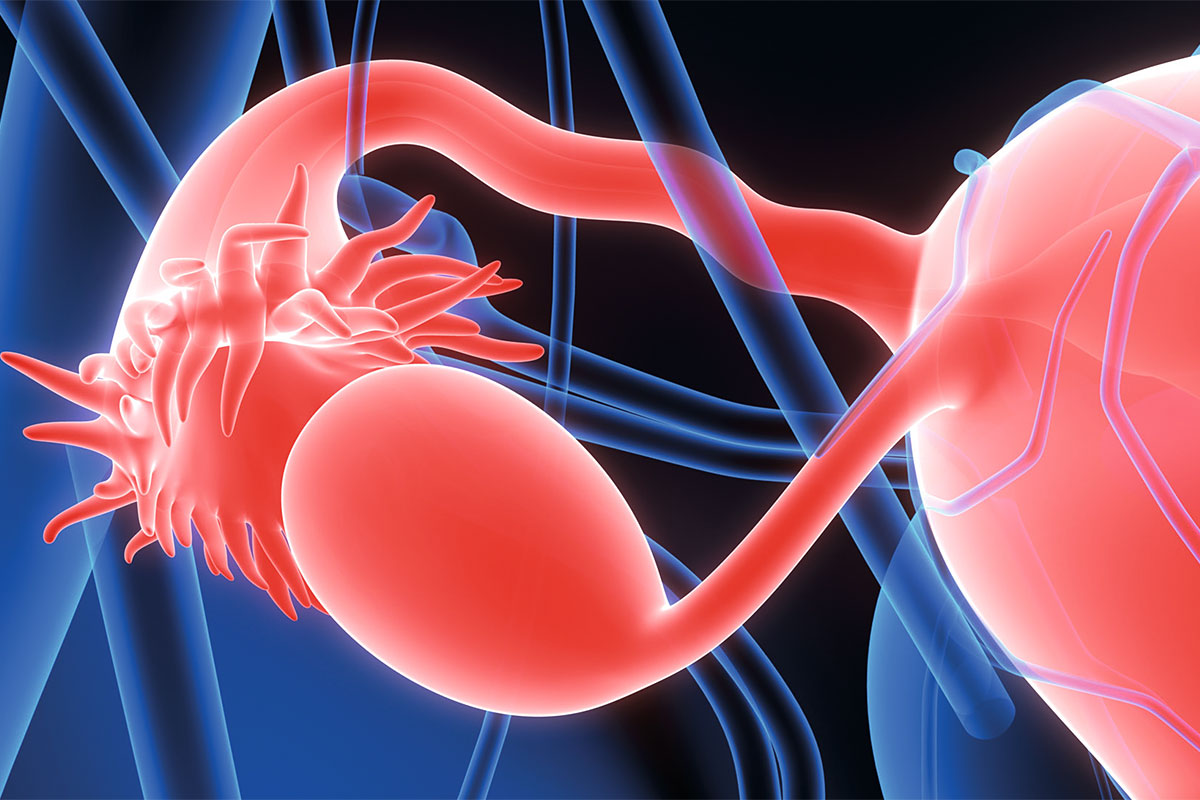 Chlamydien können bei einer Infektion von der Vagina über die Gebärmutter bis in die Eileiter wandern und sich dort einnisten. In den Eileitern liegt zumeist auch der Ursprung von Eierstockkrebs.