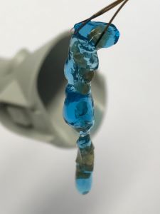Blaues Gel mit Nierensteinresten, die über ein Endoskop aus dem Körper entfernt wurden. Blaues Gel mit Nierensteinresten, die über ein Endoskop aus dem Körper entfernt wurden.