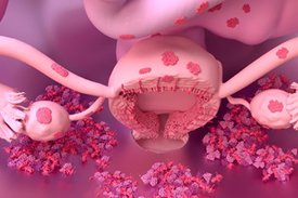 Rosa farbenes Modell einer Gebärmutter mit außerhalb liegenden, pink dargestellten, Endometriose-Zellen