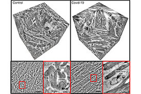 Herzgewebe im gesunden Zustand (links) und bei schwerem Verlauf von Covid-19 (rechts).