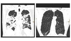 Röntgenbild von Lunge