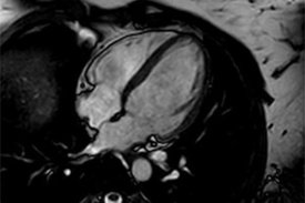 MRT-Aufnahme des Herzens, ein sogenannter 4-Kammerblick.