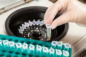 Mehr als 7.700 Gewebeproben hat ein internationales Wissenschaftsteam untersucht und dabei einen molekularen Marker gefunden, der zuverlässig anzeigen kann, wie bösartig ein Prostatatumor ist.