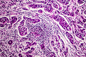 Mikrofotografie von Lymphknotenmetastase