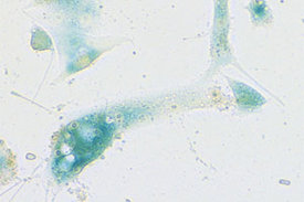 Zellen der menschlichen Nasenschleimhaut, die infolge einer SARS-CoV-2-Infektion das Seneszenzprogramm gestartet haben.