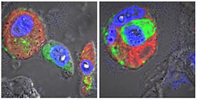 Mikroskopische Aufnahmen von Lungengewebe eines an COVID-19 Verstorbenen