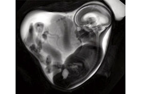 Die fetale MRT ist eine spezialisierte Bildgebungsmethode der pränatalen Diagnostik, die etwa ab der 18. Schwangerschaftswoche eingesetzt werden kann.